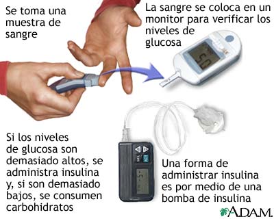 Bomba de insulina