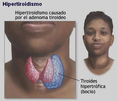 Hipertiroidismo